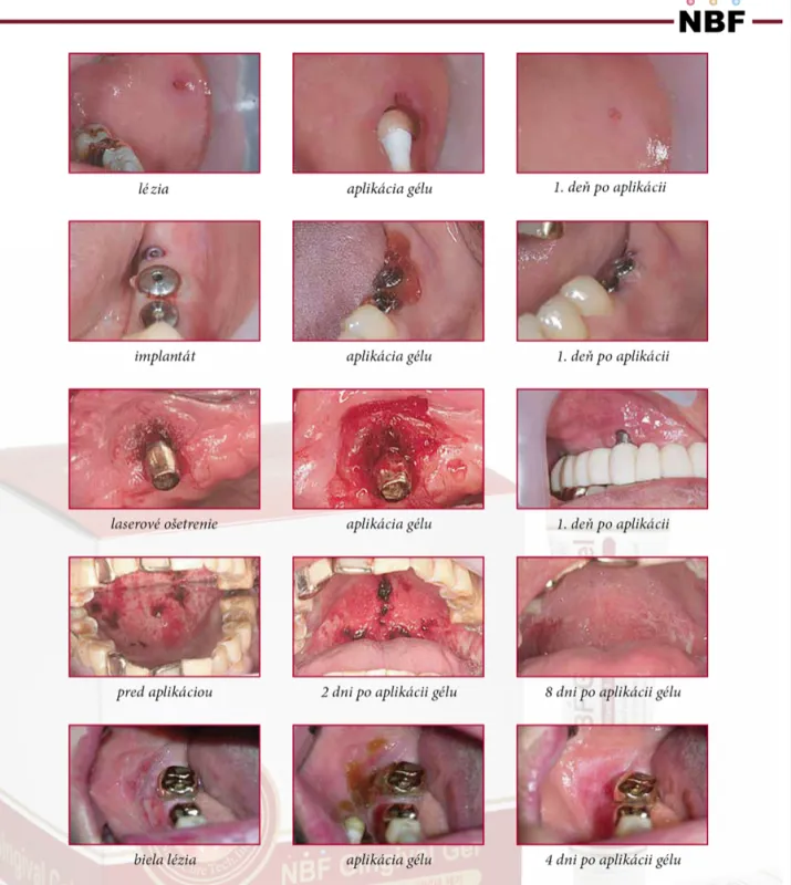 NBF GINGIVAL GÉL 2x30 g 3