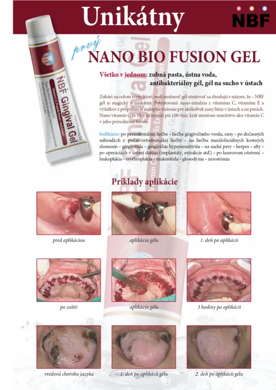 NBF GINGIVAL GÉL 2x30 g 2